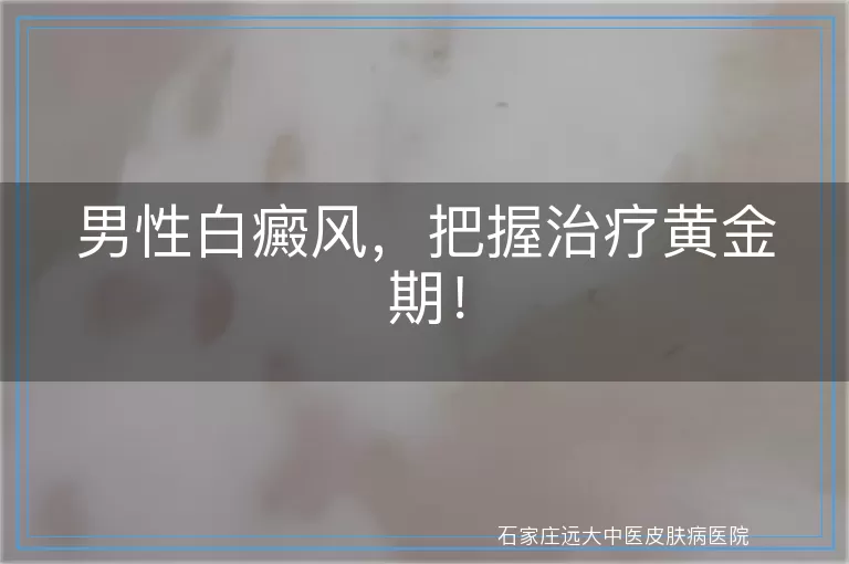 男性白癜风，把握治疗黄金期！
