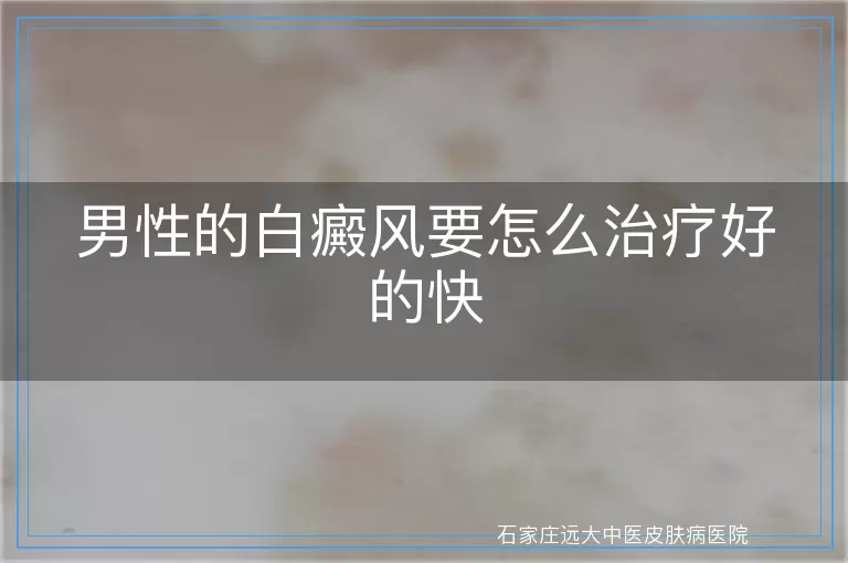 男性的白癜风要怎么治疗好的快