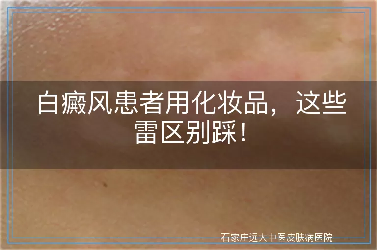 白癜风患者用化妆品，这些雷区别踩！