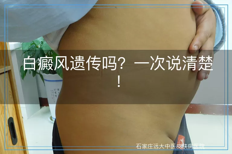 白癜风遗传吗？一次说清楚！