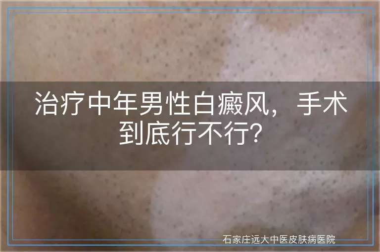 治疗中年男性白癜风，手术到底行不行？