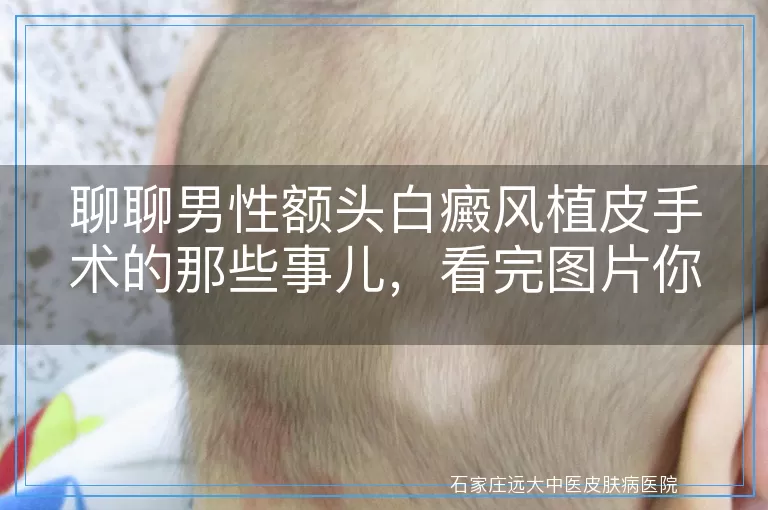 聊聊男性额头白癜风植皮手术的那些事儿，看完图片你就懂了