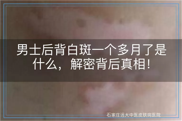 男士后背白斑一个多月了是什么，解密背后真相！