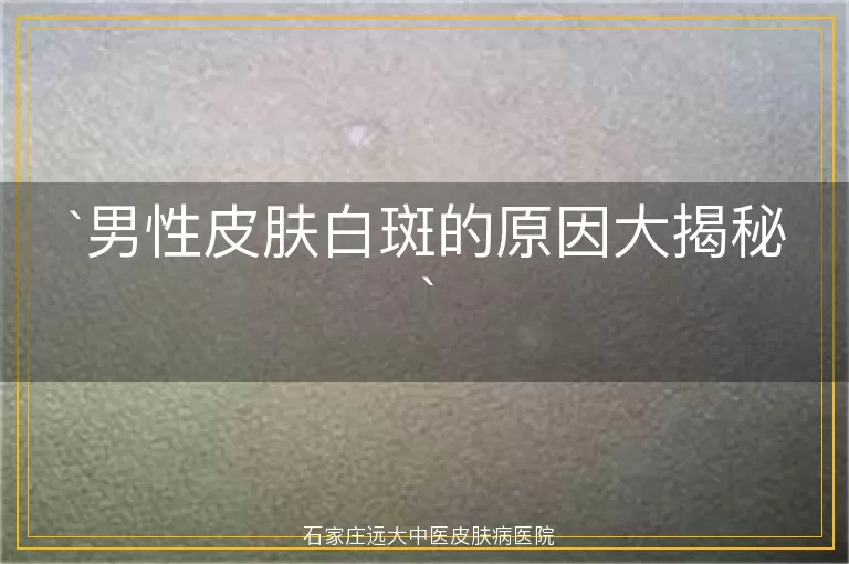男性皮肤白斑的原因大揭秘