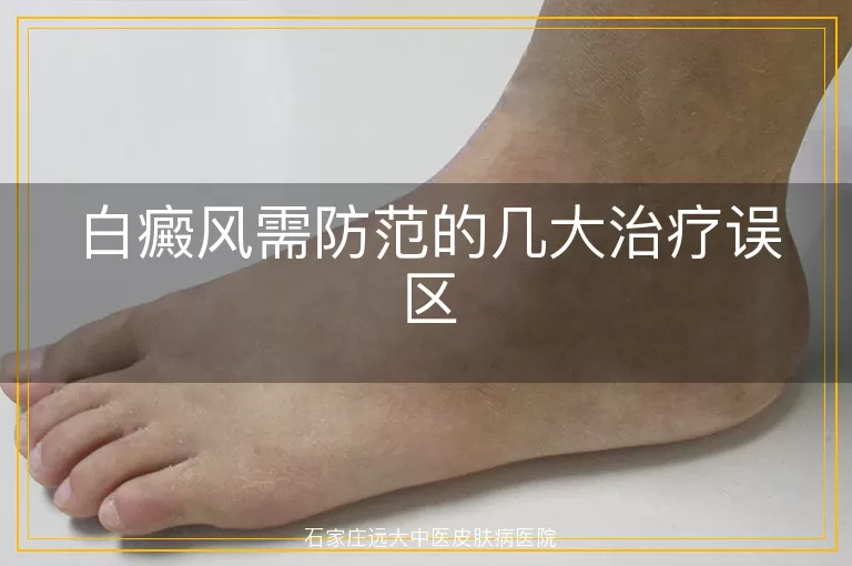 白癜风需防范的几大治疗误区