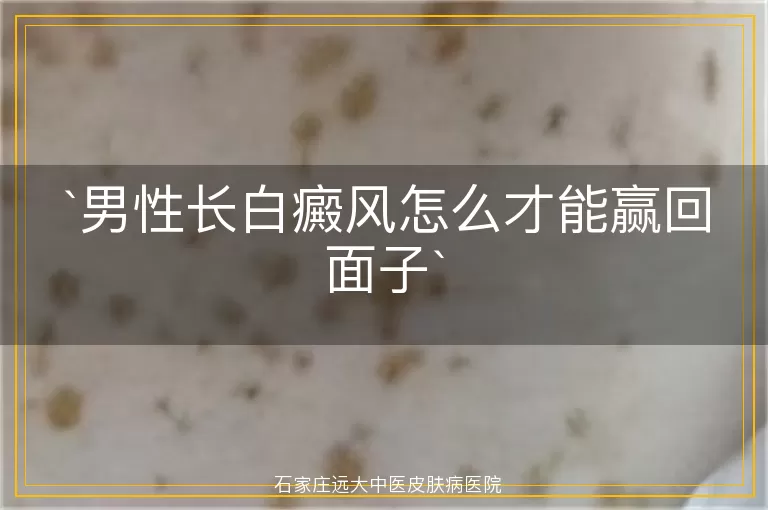 男性长白癜风怎么才能赢回面子