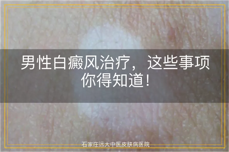 男性白癜风治疗，这些事项你得知道！