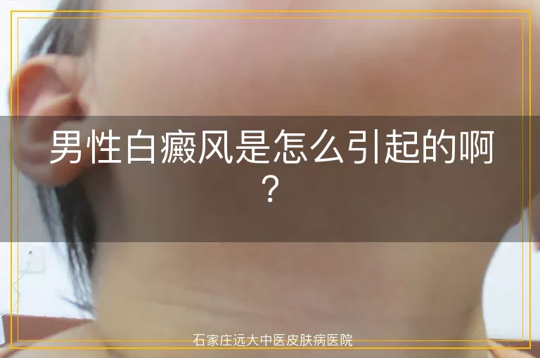 男性白癜风是怎么引起的啊？