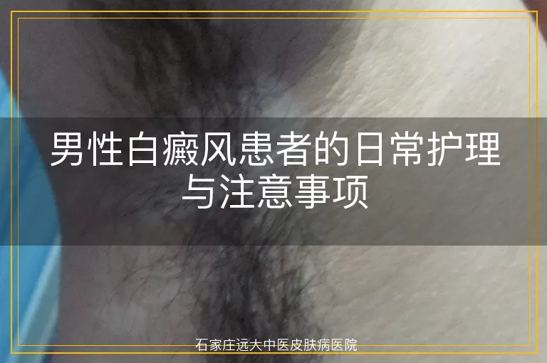 男性白癜风患者的日常护理与注意事项