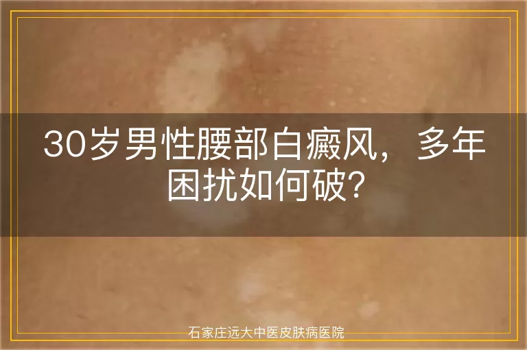 30岁男性腰部白癜风，多年困扰如何破？