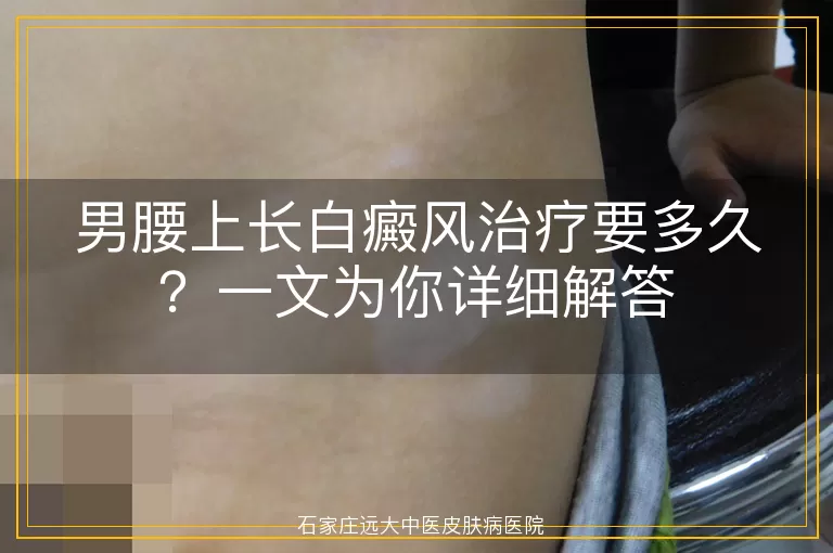 男腰上长白癜风治疗要多久？一文为你详细解答