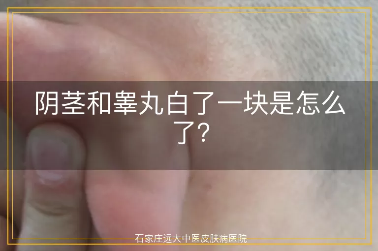 阴茎和睾丸白了一块是怎么了？