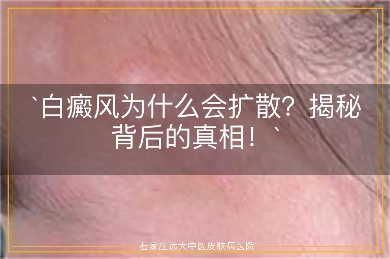 白癜风为什么会扩散？揭秘背后的真相！