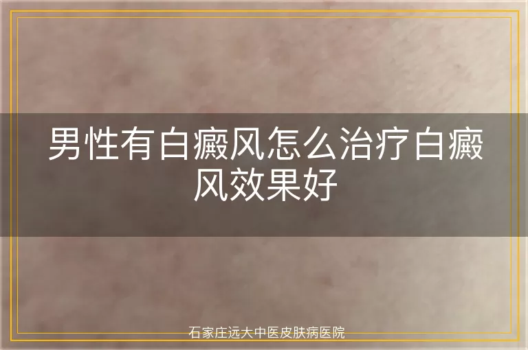 男性有白癜风怎么治疗白癜风效果好