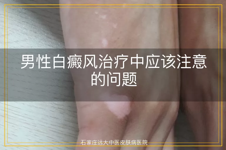 男性白癜风治疗中应该注意的问题