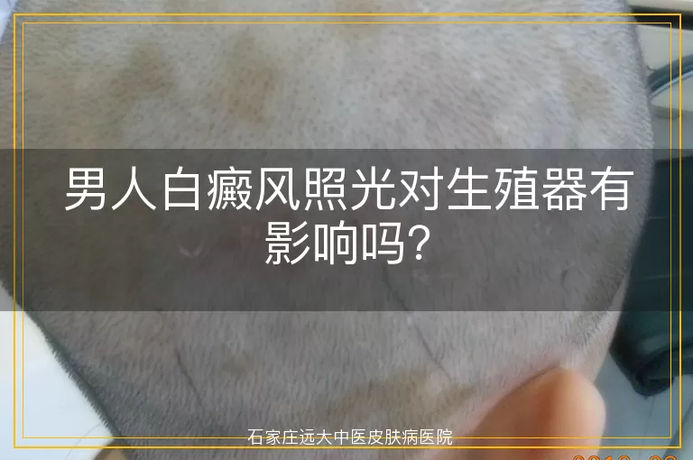 男人白癜风照光对生殖器有影响吗？