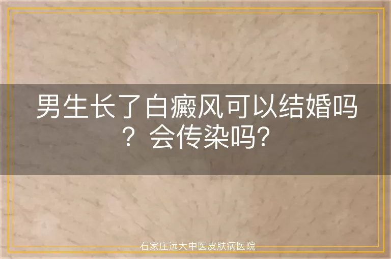 男生长了白癜风可以结婚吗？会传染吗？
