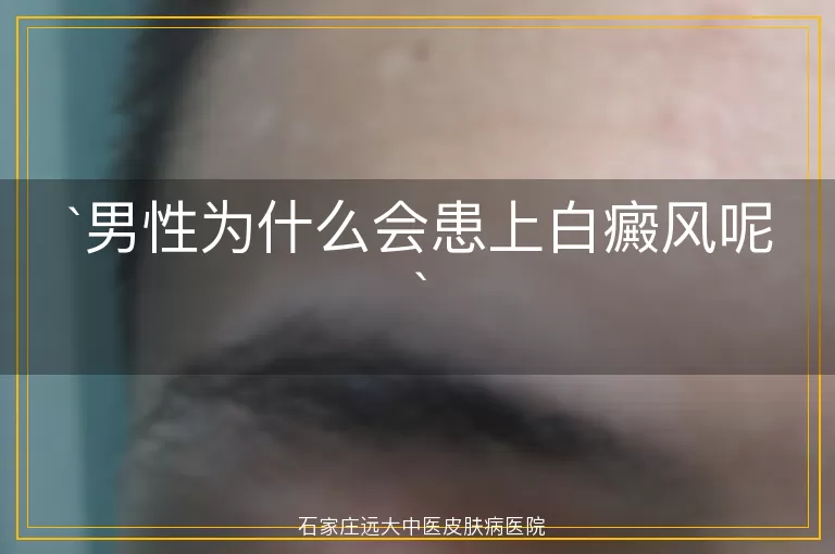 男性为什么会患上白癜风呢