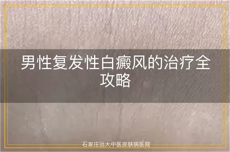 男性复发性白癜风的治疗全攻略