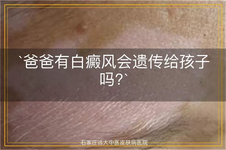爸爸有白癜风会遗传给孩子吗?