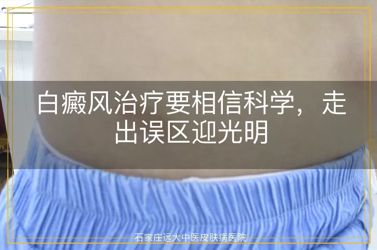 白癜风治疗要相信科学，走出误区迎光明