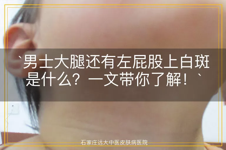 男士大腿还有左屁股上白斑是什么？一文带你了解！