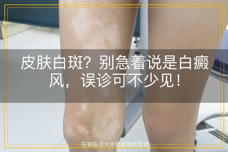 皮肤白斑？别急着说是白癜风，误诊可不少见！