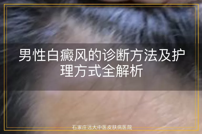 男性白癜风的诊断方法及护理方式全解析