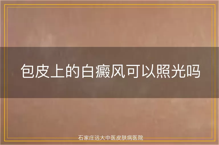 包皮上的白癜风可以照光吗
