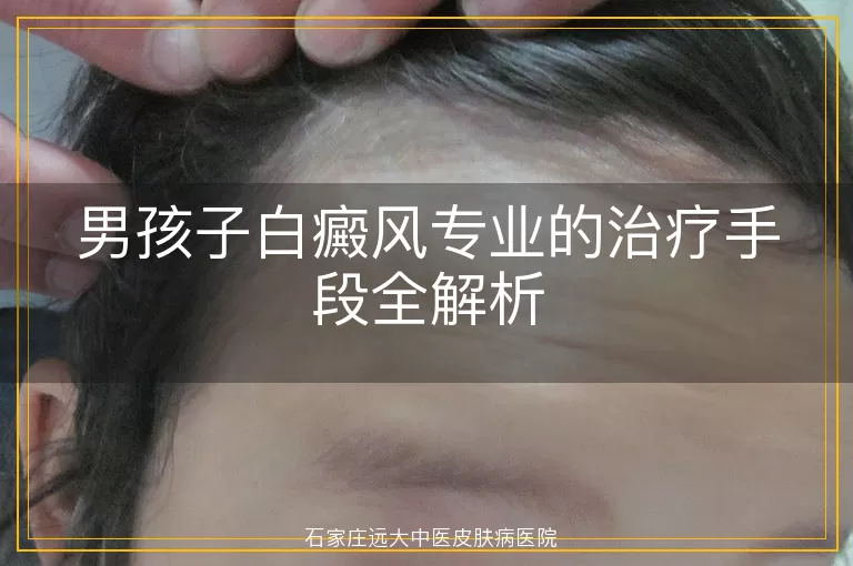 男孩子白癜风专业的治疗手段全解析