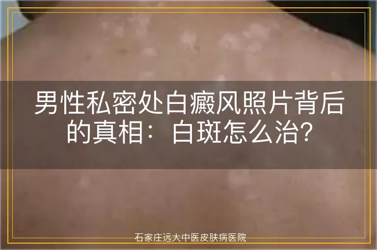 男性私密处白癜风照片背后的真相：白斑怎么治？