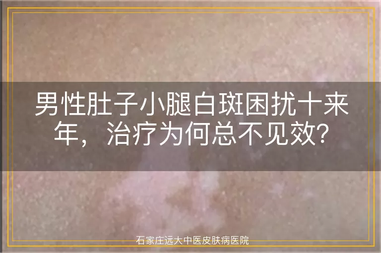 男性肚子小腿白斑困扰十来年，治疗为何总不见效？