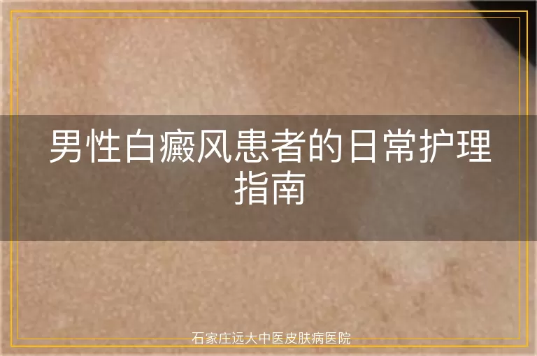 男性白癜风患者的日常护理指南