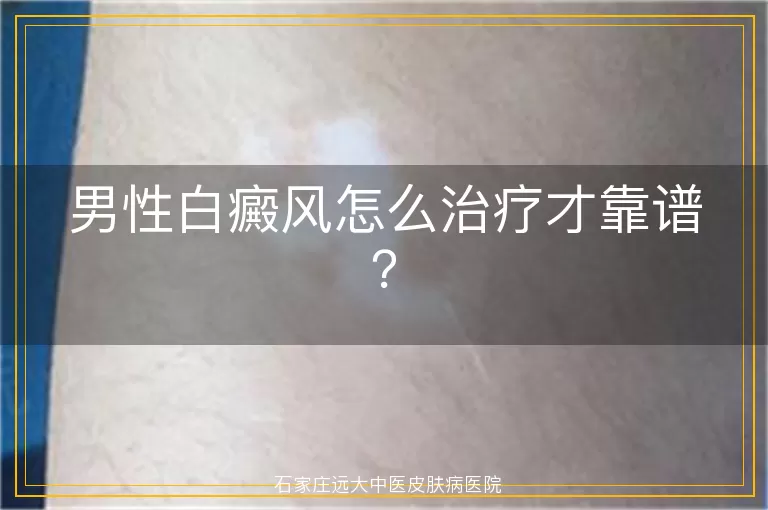 男性白癜风怎么治疗才靠谱？