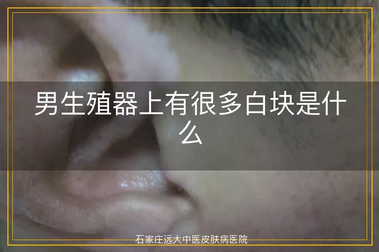 男生殖器上有很多白块是什么