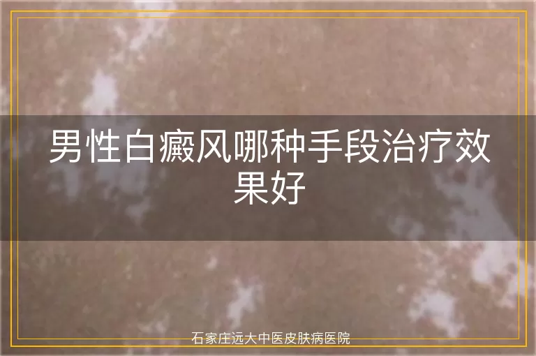男性白癜风哪种手段治疗效果好