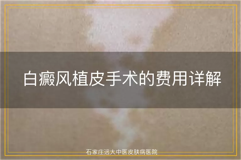 白癜风植皮手术的费用详解