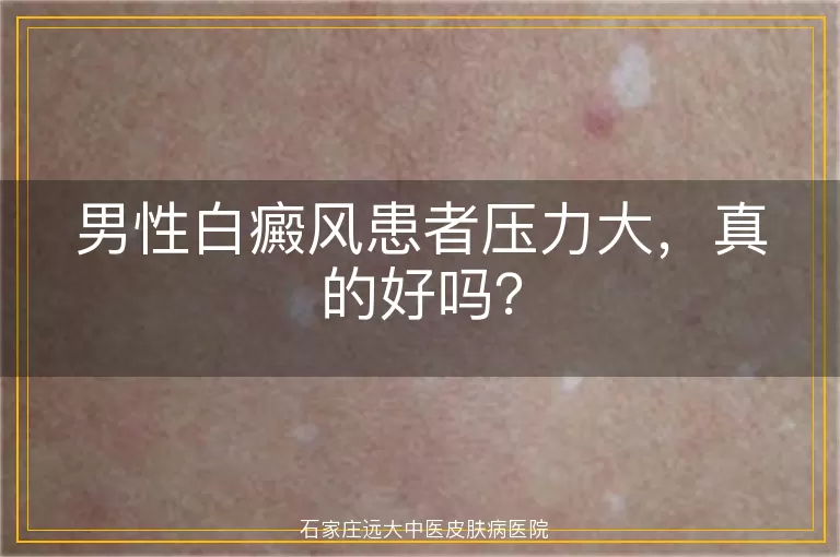 男性白癜风患者压力大，真的好吗？