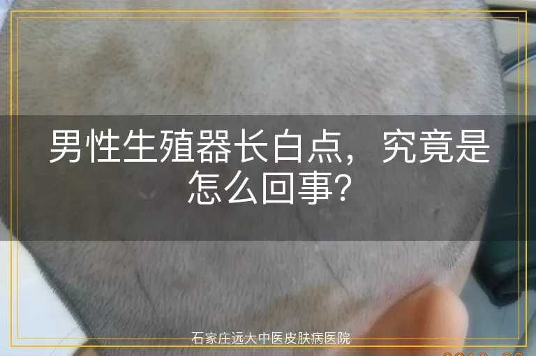 男性生殖器长白点，究竟是怎么回事？