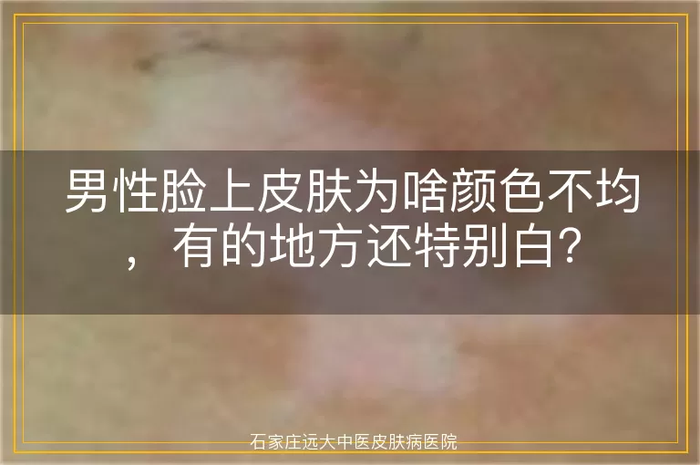 男性脸上皮肤为啥颜色不均，有的地方还特别白？