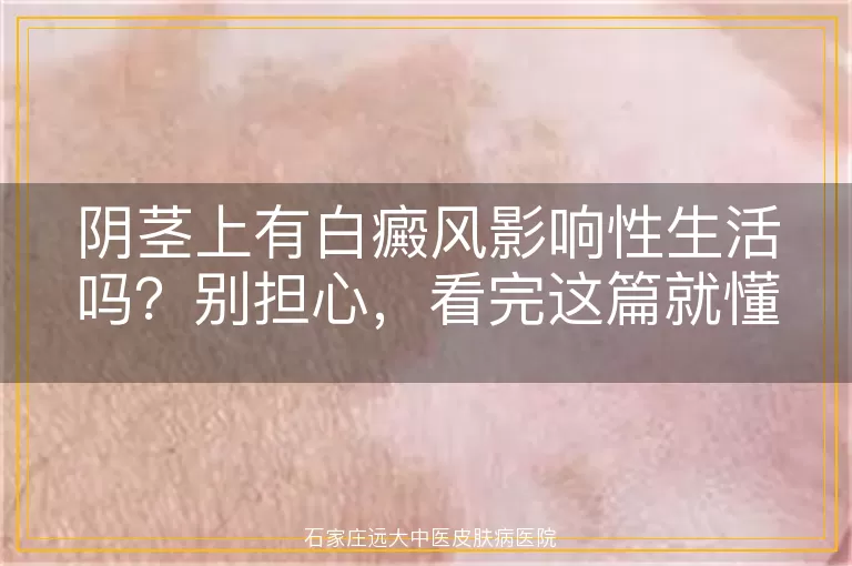 阴茎上有白癜风影响性生活吗？别担心，看完这篇就懂了！