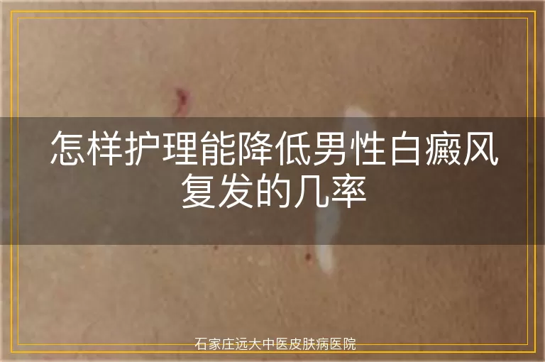怎样护理能降低男性白癜风复发的几率