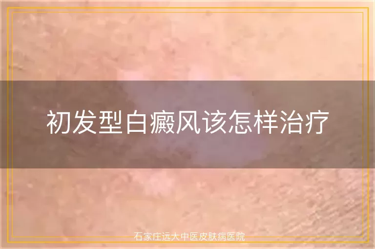 初发型白癜风该怎样治疗
