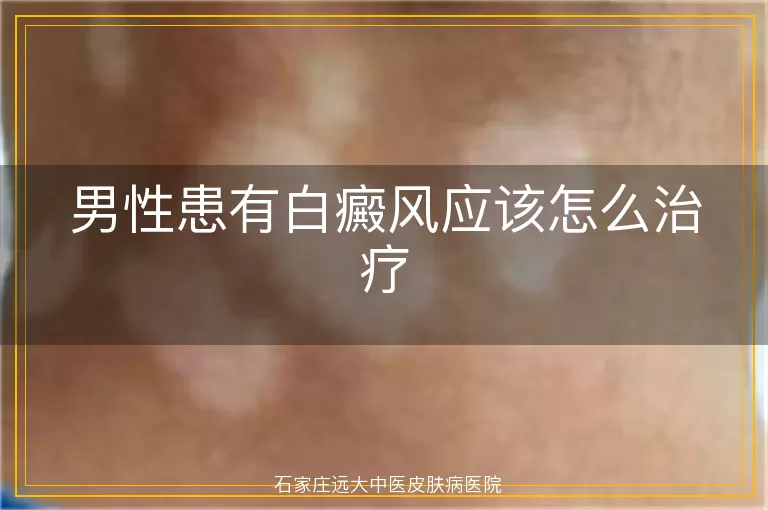 男性患有白癜风应该怎么治疗