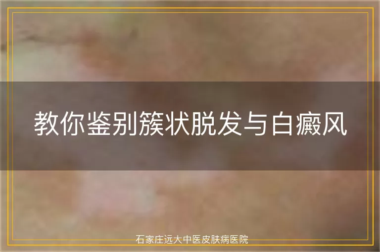 教你鉴别簇状脱发与白癜风
