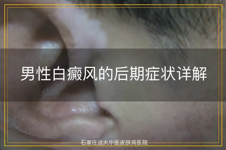男性白癜风的后期症状详解