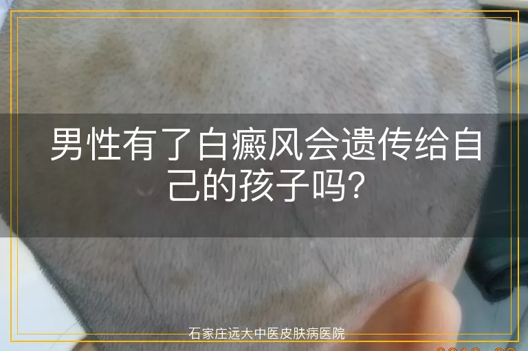 男性有了白癜风会遗传给自己的孩子吗？