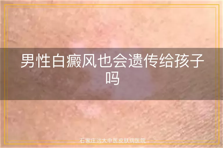 男性白癜风也会遗传给孩子吗