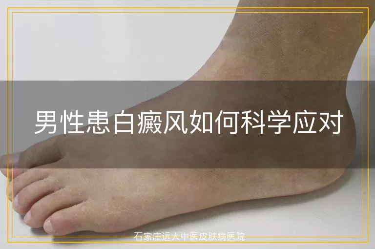 男性患白癜风如何科学应对