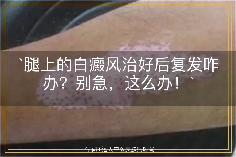 腿上的白癜风治好后复发咋办？别急，这么办！